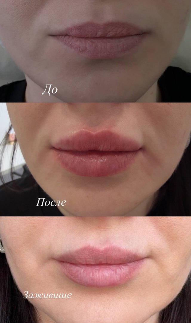 КП губ препарат Stylage M 1 мл