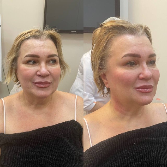 Полимолочная кислота