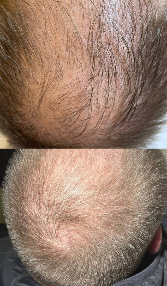 Мезотерапия кожи головы, препарат Brash Hair , 1 процедура