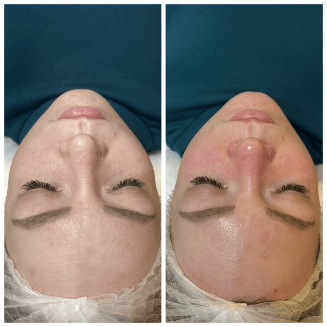 Комбинированная чистка + пилинг ормедик
