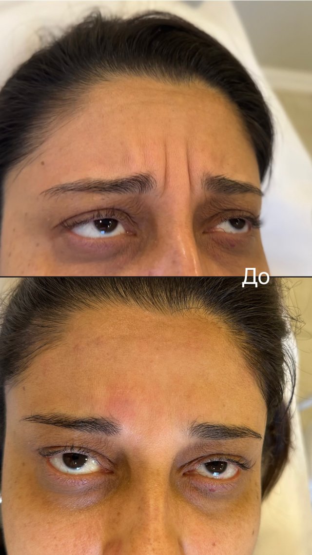 Ботулинотерапия до
