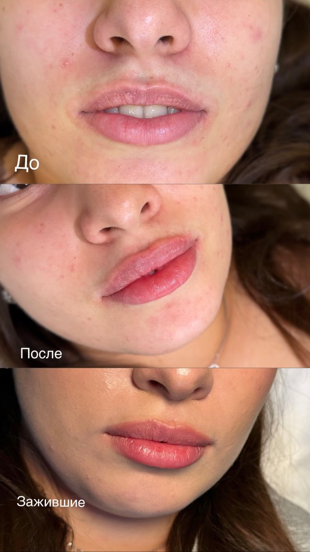 Контурная пластика губ Стилаж (Stylage)