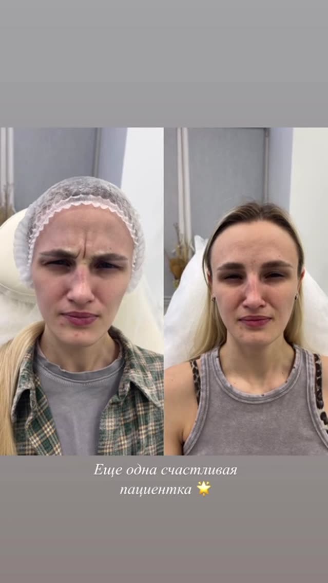Ботулинотерапия