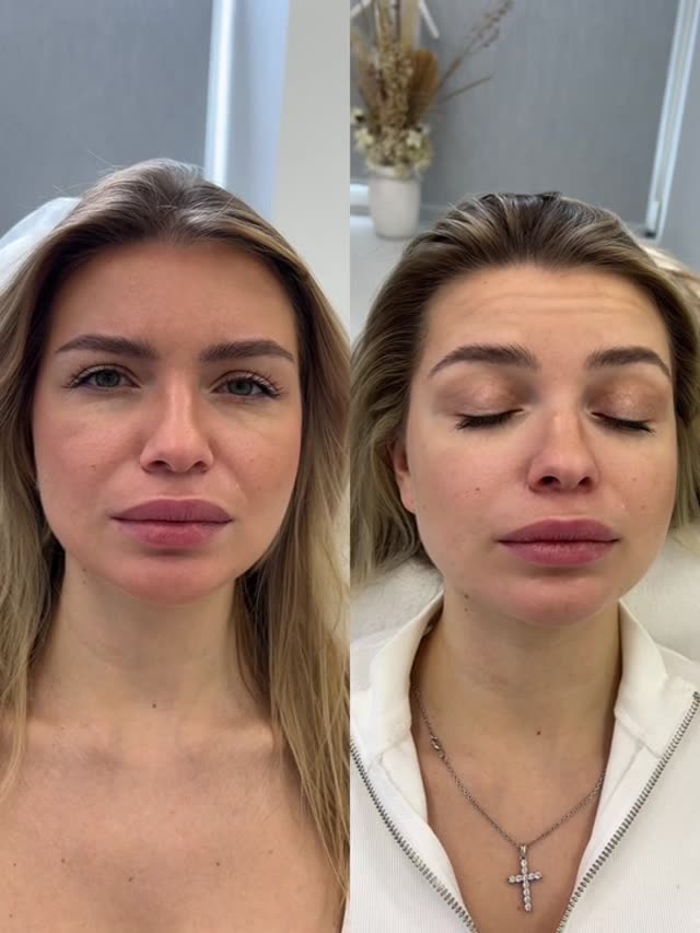 Ботулинотерапия